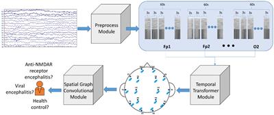 Temporal transformer-spatial graph convolutional network: an intelligent classification model for anti N-methyl-D-aspartate receptor encephalitis based on electroencephalogram signal